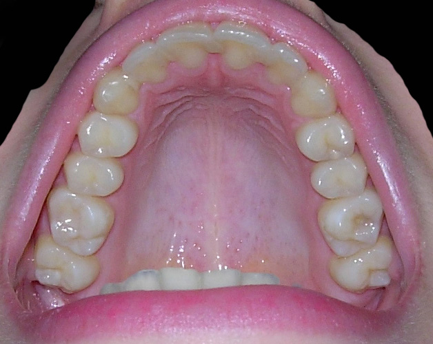 Risultati di un'ortodonzia fissa di quasi 2 anni